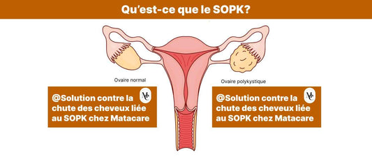 Qu'est-ce que le SOPK?
