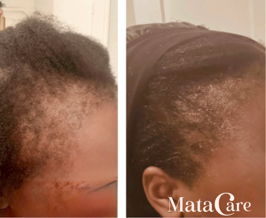 Avant apres serum pousse matacare